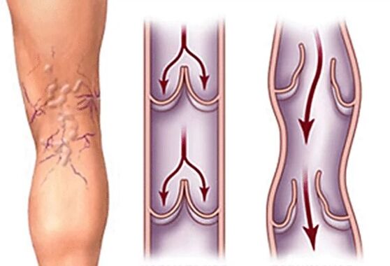Normal vein and vary
