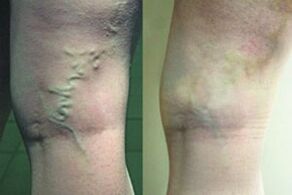 Varicose veins in the legs
