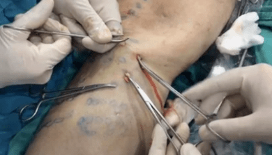How is phlebetomy performed to remove varicose veins