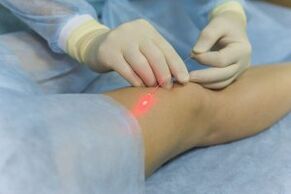 surgical intervention for varicose veins in the legs