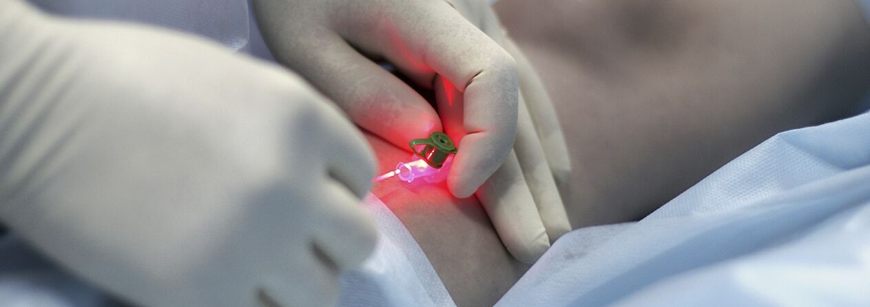 Compressive sclerotherapy