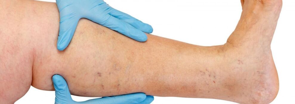Varicose veins in the leg