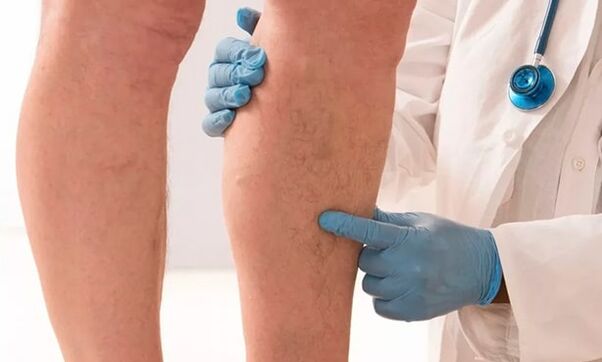 doctor examines legs for varicose veins